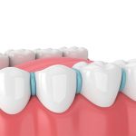 Orthodontic Elastic O Loop Separators Radiopaque 1000/Pack (Blue)